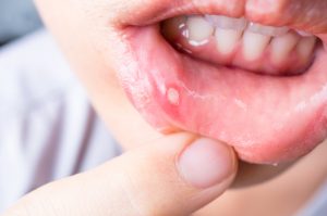 a person with bad mouth ulcers, wondering what causes mouth ulcers and treatment for mouth ulcers